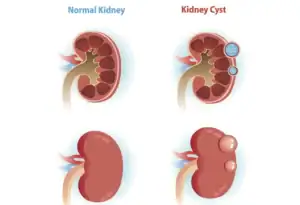 Causes of Kidney Cysts