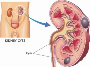 What is a Kidney Cyst?