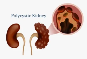 Can Kidney Cysts be Cured?