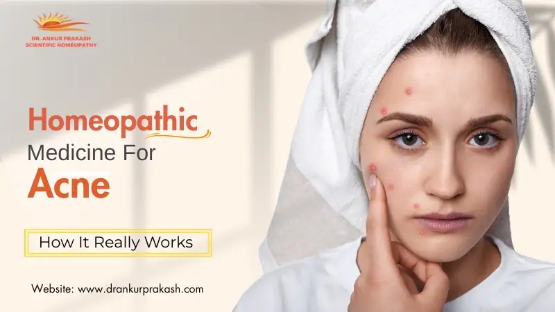 Homeopathic Medicine for Acne – How It Really Works