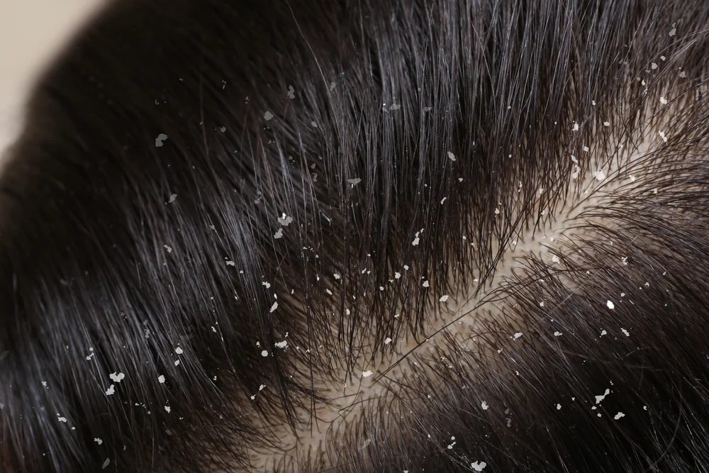 What is Dandruff?