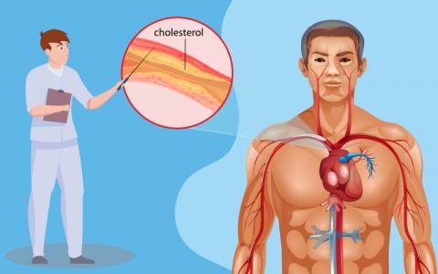 Homeopathic Medicine & Treatment for Cholesterol
