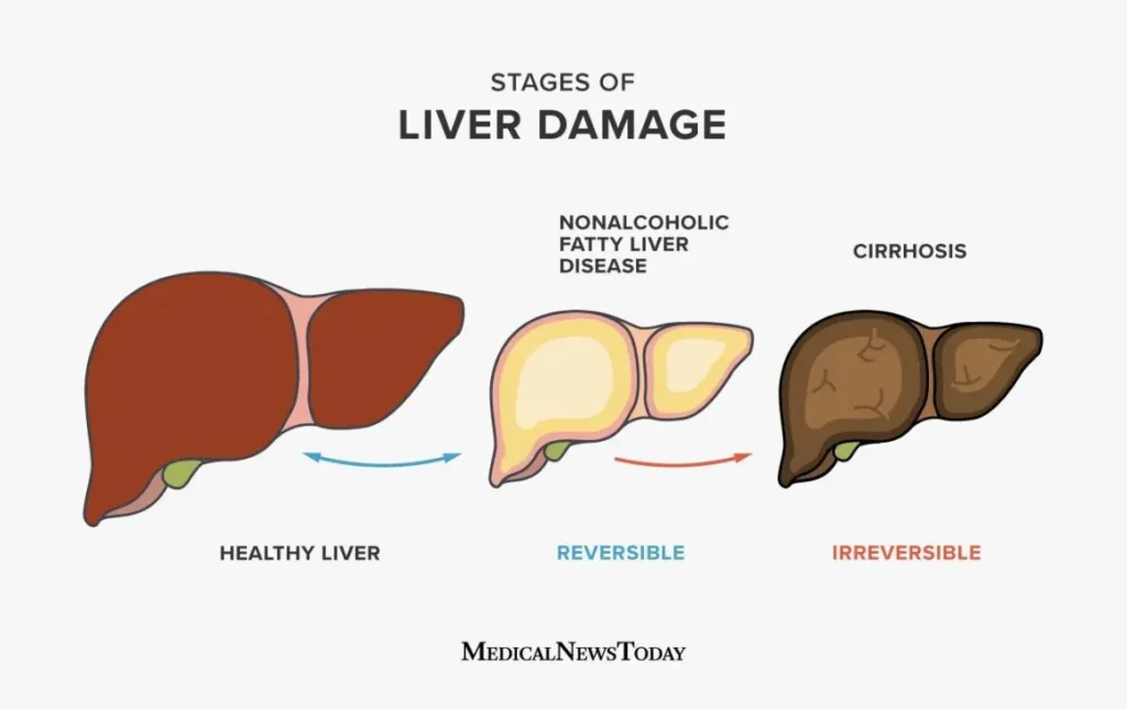Is Fatty Liver Disease a Serious Problem?