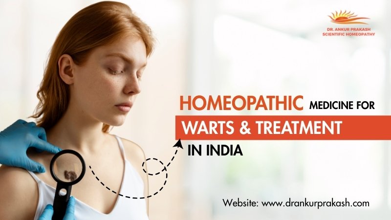 Homeopathic Medicine for Warts & Treatment in India