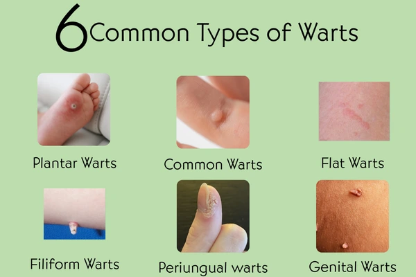 Different types of warts on skin showing various shapes and sizes