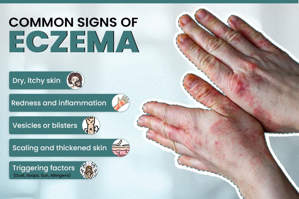Causes of Eczema in Humanbody