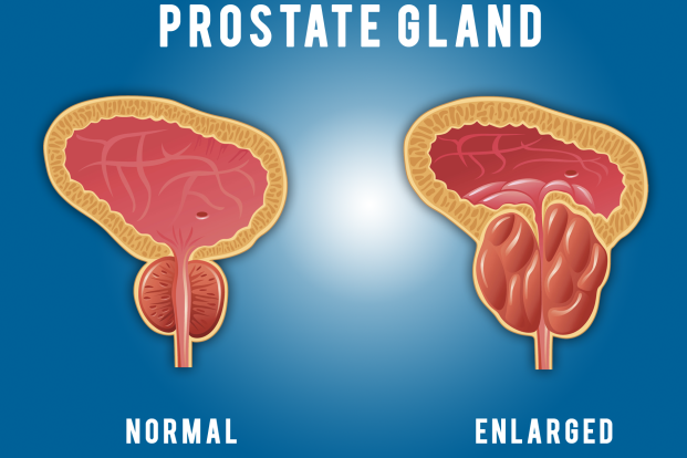 What is the Prostate in India | DR. Ankur Prakash