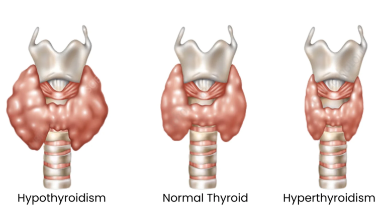 Diagram illustrating the two main types of thyroid disorders: hypothyroidism and hyperthyroidism.