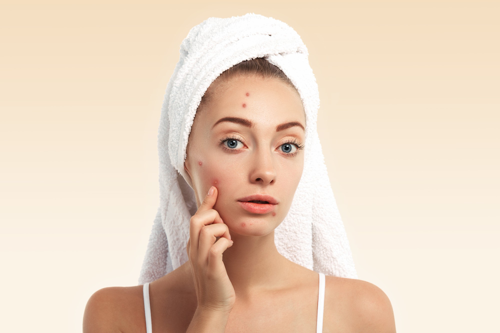 Woman showing pimples on face highlighting acne skin condition