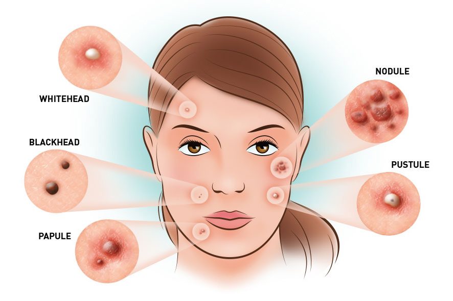 Types of pimples on face including whitehead, blackhead, papule, pustule, and nodule
