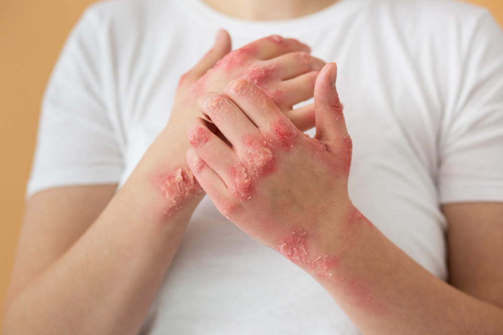 Psoriasis patches on hands showing red inflamed skin and scales