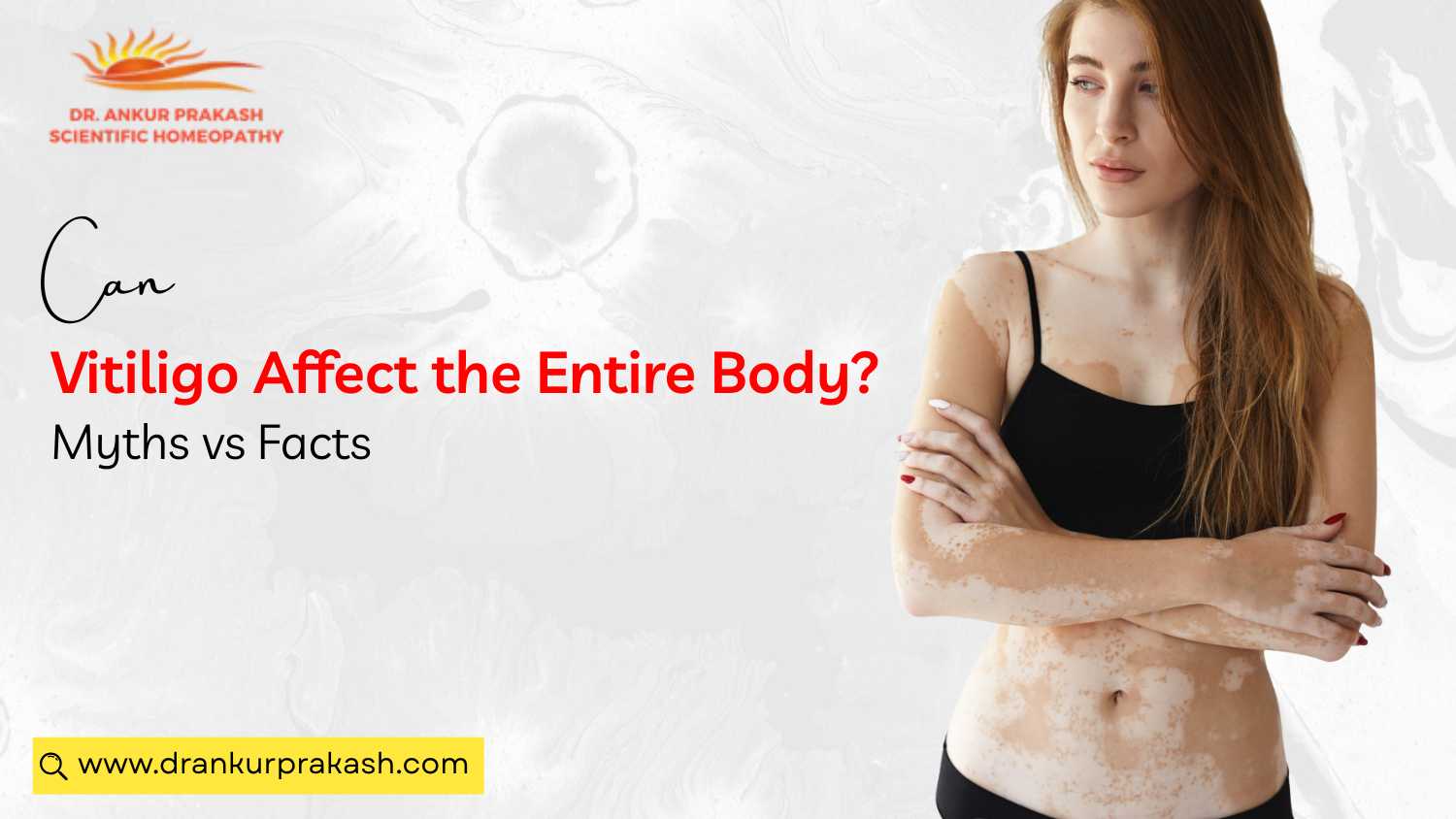 Can Vitiligo Affect the Entire Body? Myths vs Facts” and Dr. Ankur Prakash Scientific Homeopathy logo.