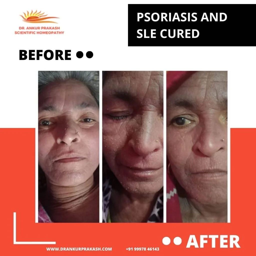 Before and after photo showing skin improvement in psoriasis patient.