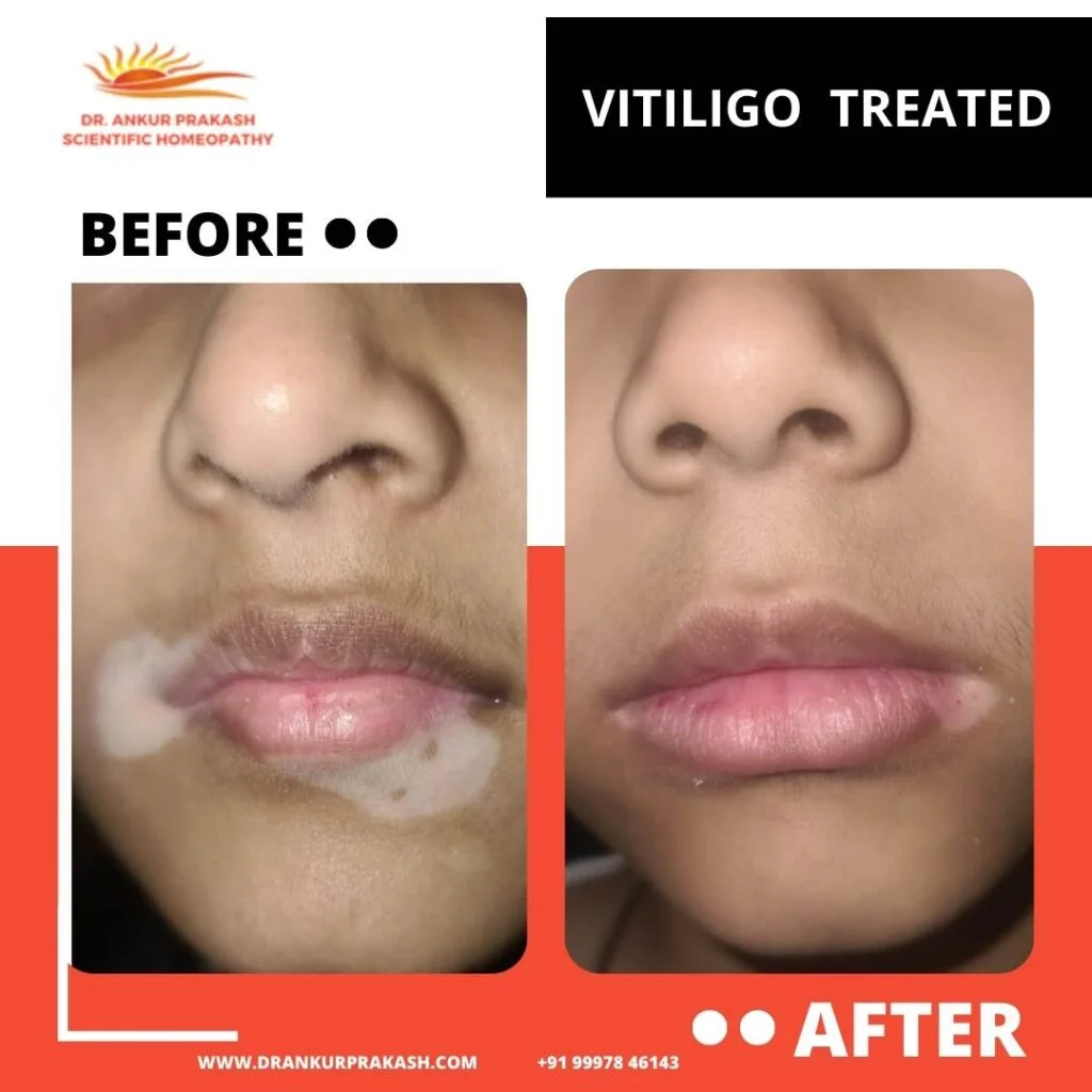 Before and after vitiligo treatment showing improved skin pigmentation around lips.