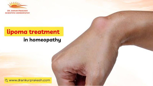 Lipoma Treatment in Homeopathy