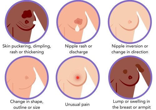 breast cancer symptoms