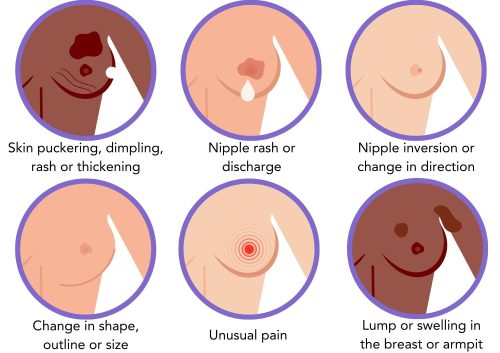 breast cancer symptoms