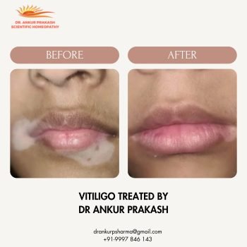 VITILIGO CURED BY DR ANKUR PRAKASH