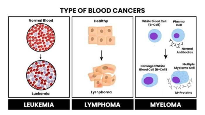 how can blood cancer be cured how can blood cancer be cured