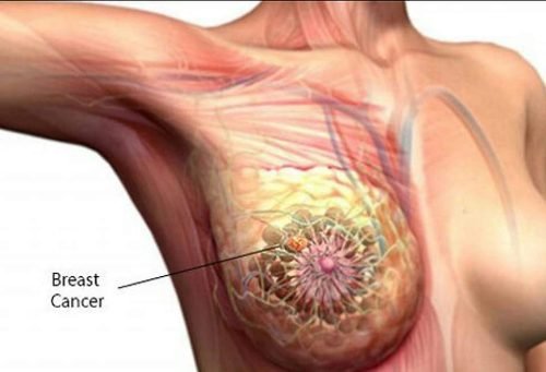 What is breast cancer What is breast cancer