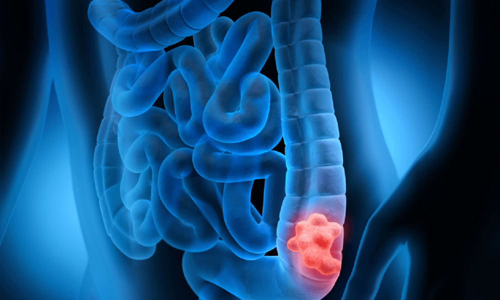 Colon_Cancer_Emerge_in_Men_and_Women