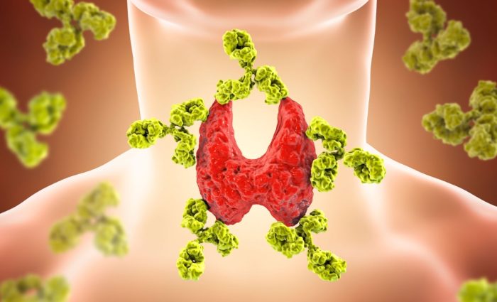 Hashimoto’s (Autoimmune Hypothyroidism).jpg