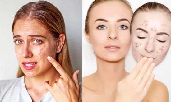 Homeopathy Treatment for Acne