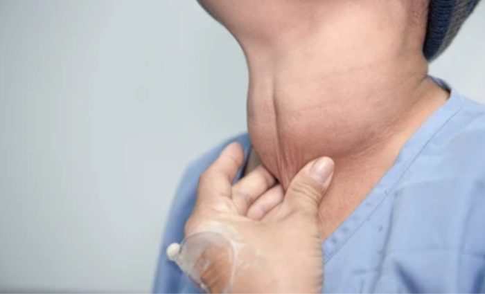 Hyperthyroidism (Overactive Thyroid).jpg