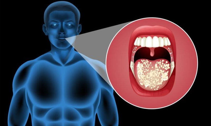 Oral_Cancer_