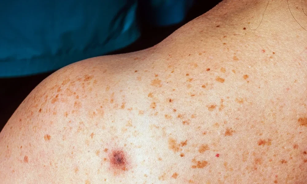 Skin Cancer