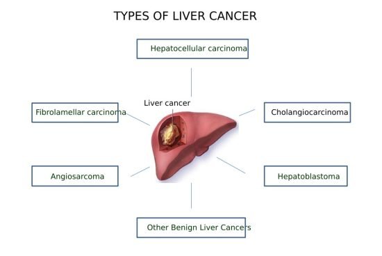 Types of Liver Cancer Types of Liver Cancer