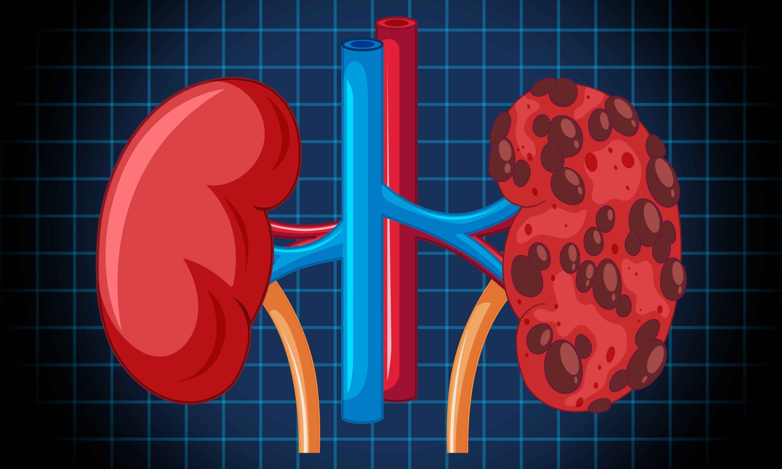 Detailed overview explaining what chronic kidney failure is and its stages