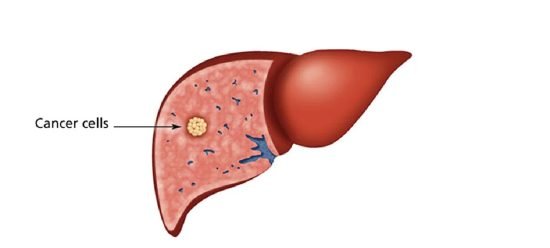 What is Liver Cancer What is Liver Cancer