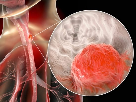 Cancer Symptoms