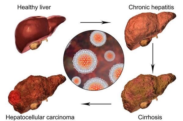 Stage 4 Cancer