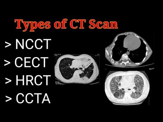 Types of CT Scan what were the results of the ct scan