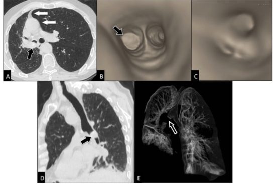 ct scan and cancer risk