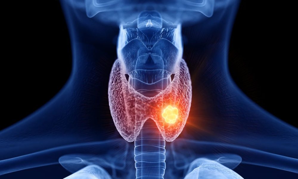 Possible complications of untreated high TSH