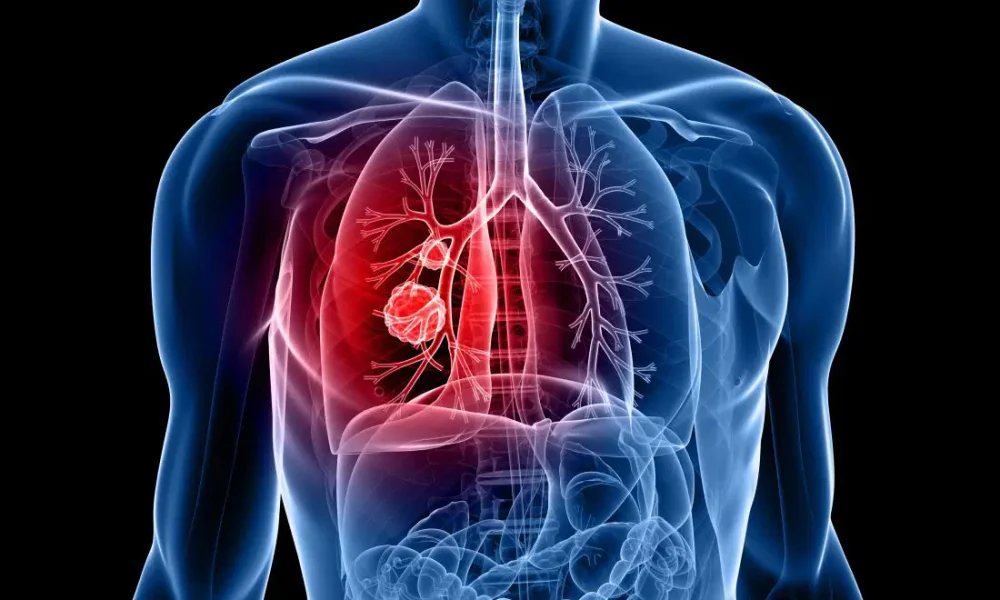 lung-cancer