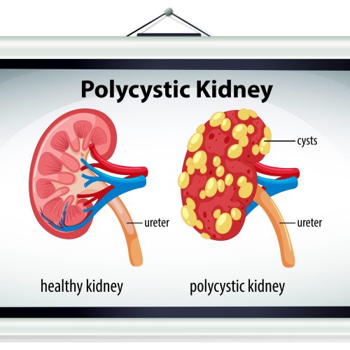 Chart showing kidney cyst sizes and which cyst sizes may be dangerous